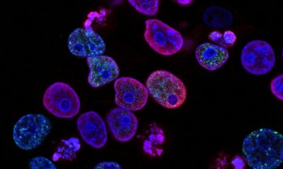 PRISM2 model uses clinical dialogue to interpret pathology slides